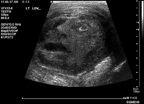 Imagem assustadora aparece ultrassom de tumor testicular