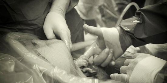 Bebê segura o dedo do médico durante cesariana