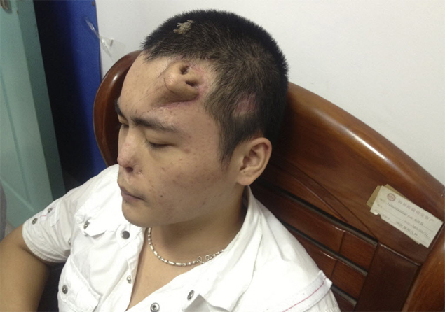 Cirurgiões chineses cultivam novo nariz na testa de paciente que perdeu parte do órgão após sofrer um acidente 