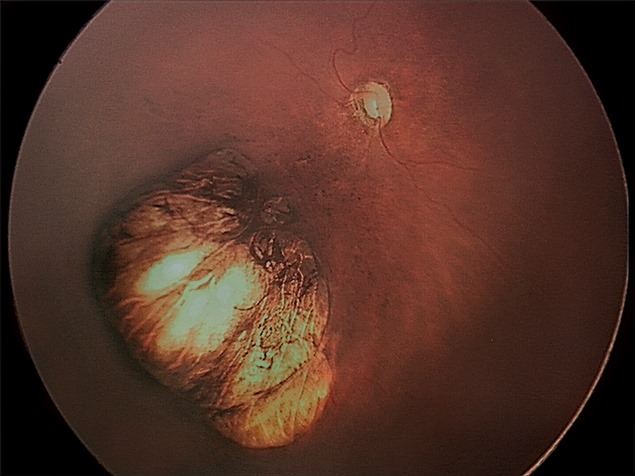 Malformed retina