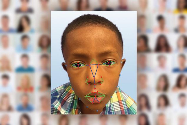 Exemplo de medidas feitas pelo software de reconhecimento facial para detectar sndromes genticas