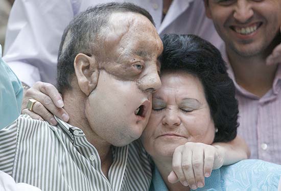 Rafael, que recebeu o transplante de rosto, abraça sua mãe, Juana, durante entrevista em Sevilha