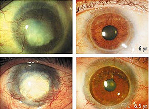 Montagem mostra olhos de dois pacientes antes e depois do tratamento com células-tronco.