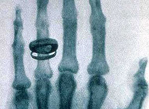 Uma das primeiras radiografias mostra mão da mulher do físico Wilhelm Röntgen; o objeto arredondado é um anel