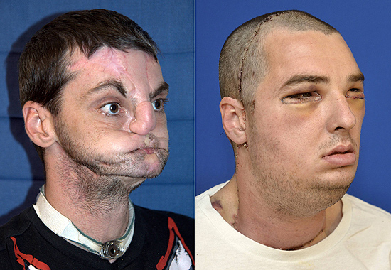 O americano Richard Norris antes e depois do transplante de rosto 