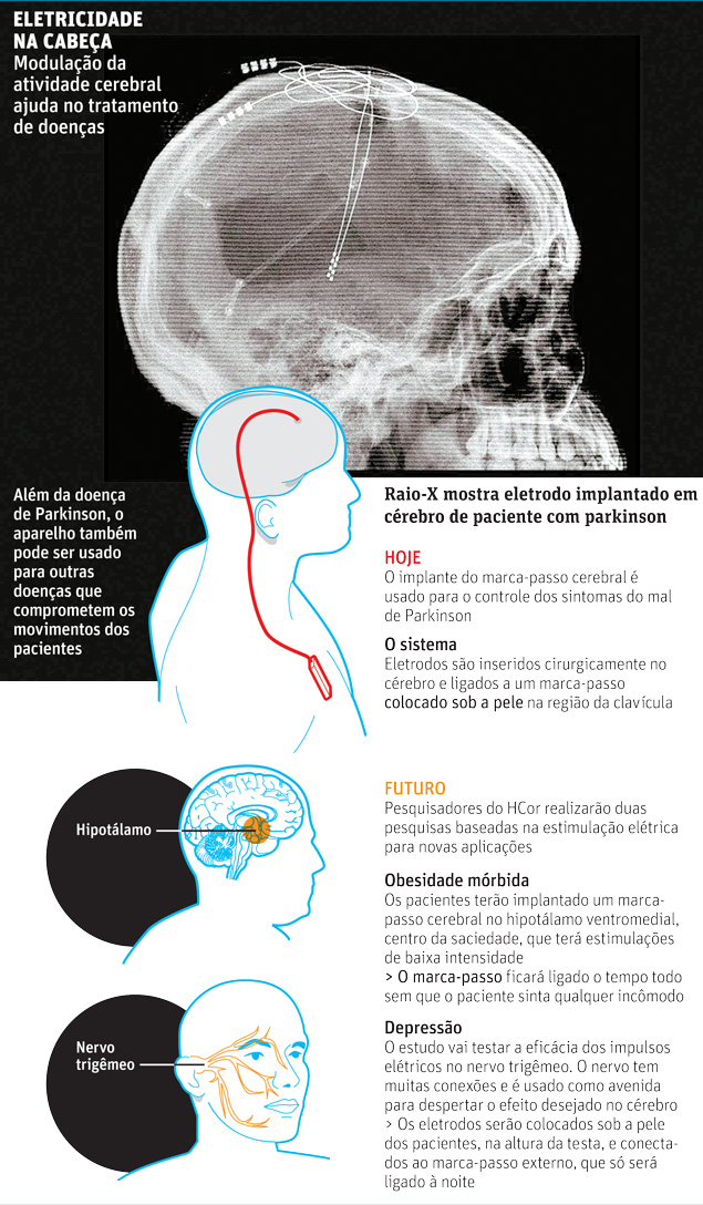 Eletricidade na cabeça Modulação da atividade cerebral ajuda no tratamento de doenças