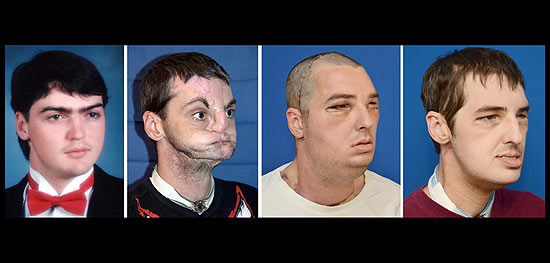Richard Lee Norris, 37, que teve o rosto transplantado. Na primeira foto, Norris jovem. Na segunda, após o acidente, em 1997. Em seguida, um mês após a cirurgia, e na última, sete meses após o transplante.