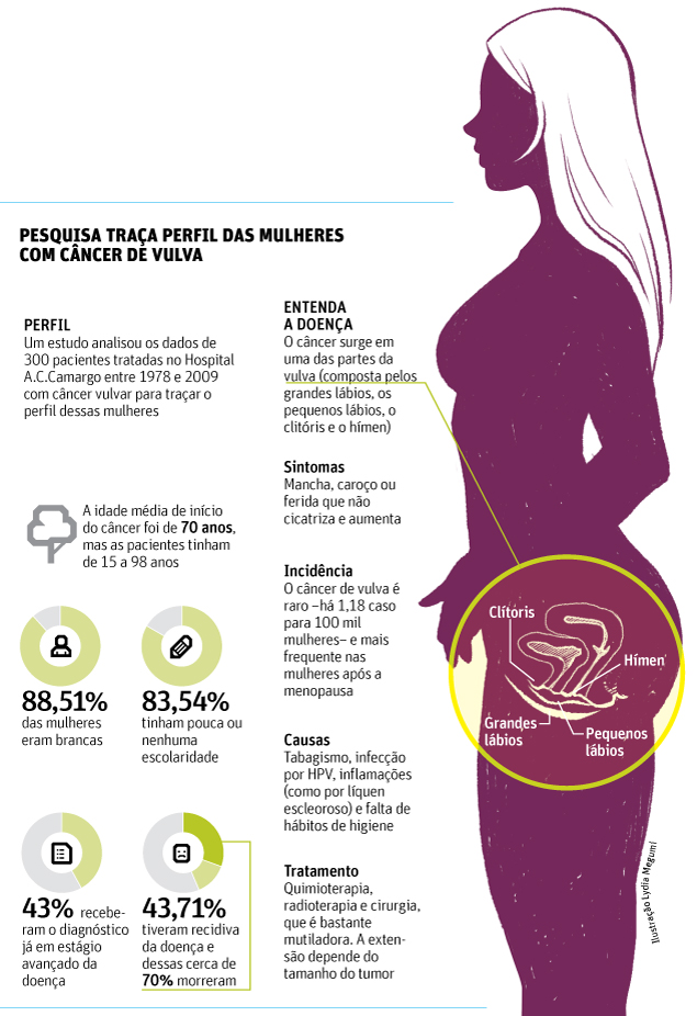 Pesquisa traça perfil de mulheres com câncer de vulva no Brasil