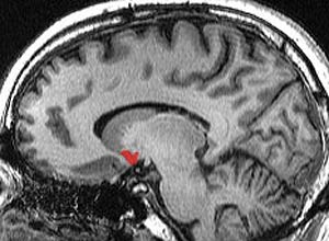 Creado por un brasileño, el nuevo método que mide la presión cerebral llega a hospitales
