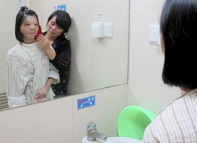 Xu Jianmei, 17, com sua mãe, depois da cirurgia de reconstrução de face em um hospital em Fuzhou, província de Fujian