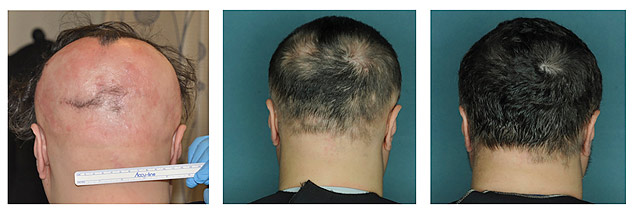 Montagem de fotos mostra paciente com alopecia areata no incio, aos trs meses de tratamento e aos quatro meses de uso de um novo remdio