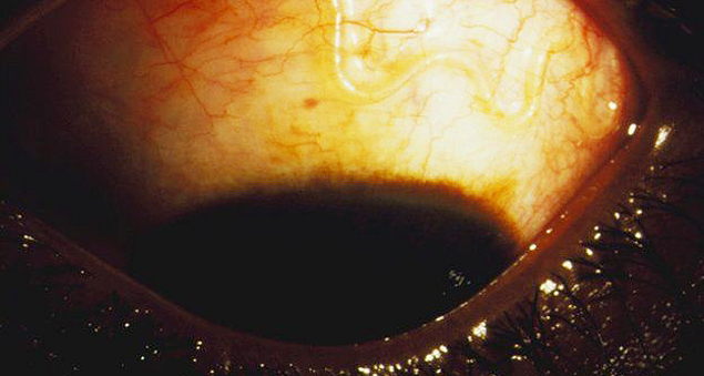 Em níveis altos, parasita loa loa pode apercer até mesmo no olho