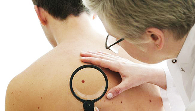 Estudo foi feito com 436 pacientes que tinham melanomas inoperveis