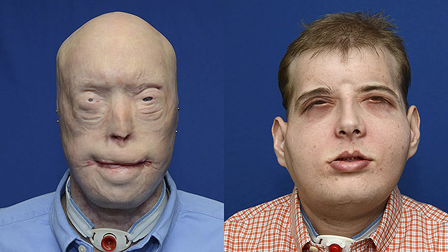 O bombeiro voluntrio Patrick Hardison, 41, fez um transplante facial aps se ferir em uma ocorrncia