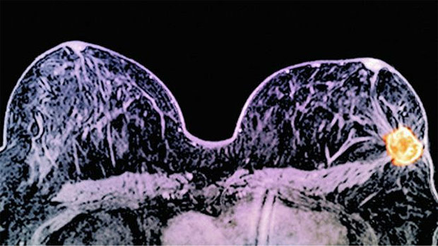 Exame de imagem de mama detecta tumor