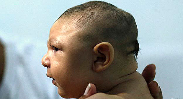 O vrus  associado a um boom nos casos de microcefalia