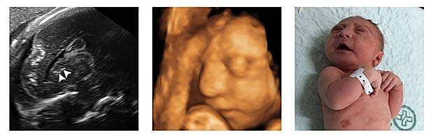 Imagem de beb com microcefalia