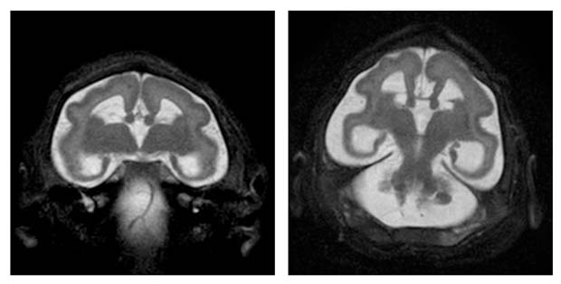 Tomografia de beb com microcefalia