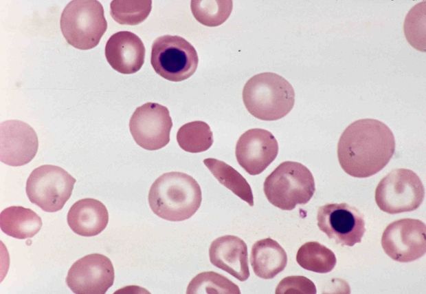 A anemia falciforme  causada por uma hemoglobina anormal
