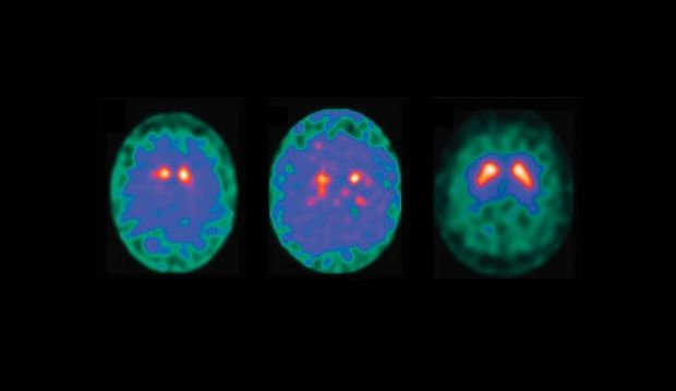  esquerda e ao centro, crebros com Parkinson;  direita, um normal; a enfermidade  caracterizada pela perda da transmisso nervosa dependente da substncia dopamina