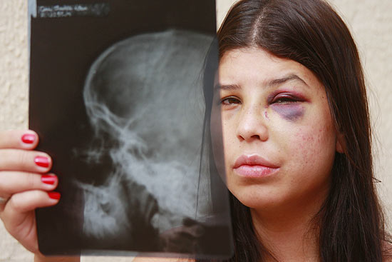 A estudante de enfermagem Ana Cláudia Karen Lauer, 20, com o raio-X de seu nariz, em casa no interior de SP