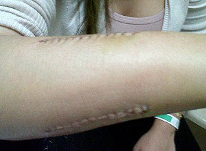 Estudante tem braço quebrado no Rio Grande do Norte