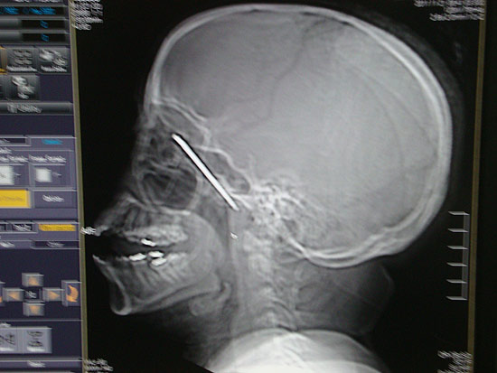 Mulher é agredida a facadas e tem parte da lâmina cravada na cabeça, no interior de São Paulo