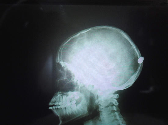 Imagem de exame clínico que apontou a existência de uma bala na cabeça do adolescente em Ribeirão
