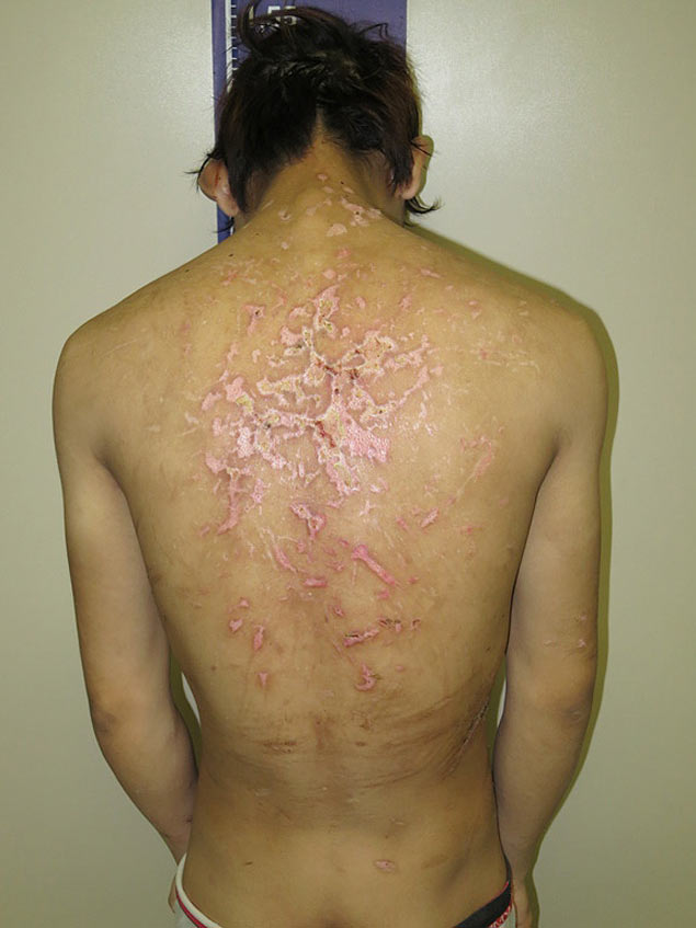 Marcas de agresses nas costas do funcionrio da pastelaria; de nacionalidade chinesa, jovem de 22 anos foi hospitalizado