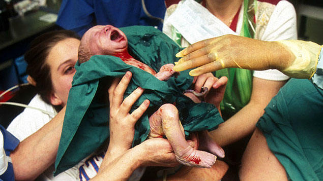 Brasil é líder de cesáreas; no parto normal, bebê vai direto para o colo da mãe