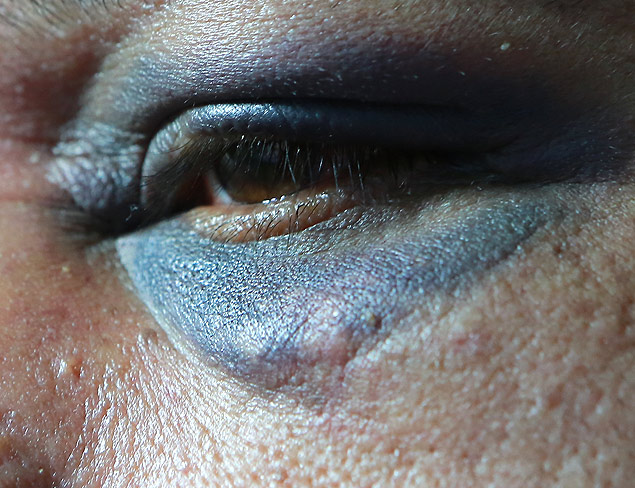 Detalhe do olho do funcionário agredido no sábado (12) na Fundação Casa de Ribeirão Preto
