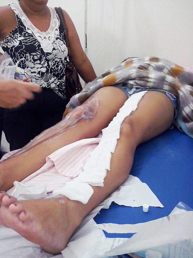 Estudante Nathlia de Souza Santos, 17, que diz ter sofrido queimaduras nas pernas em trote violento em Adamantina (SP) 