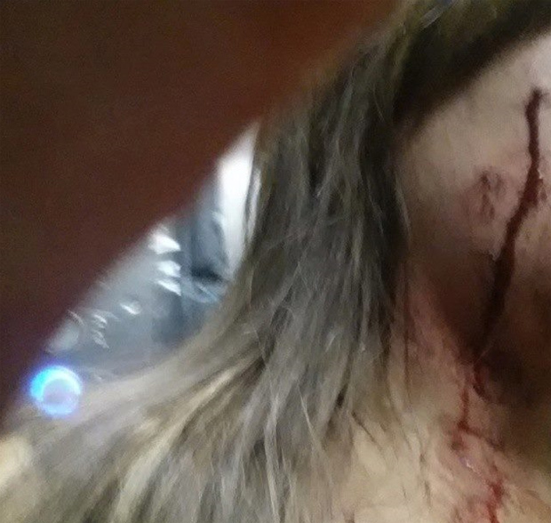 Monique Prada posta foto com o rosto machucado aps ser agredida por torcedores do Grmio na sada do estdio Beira-Rio 
