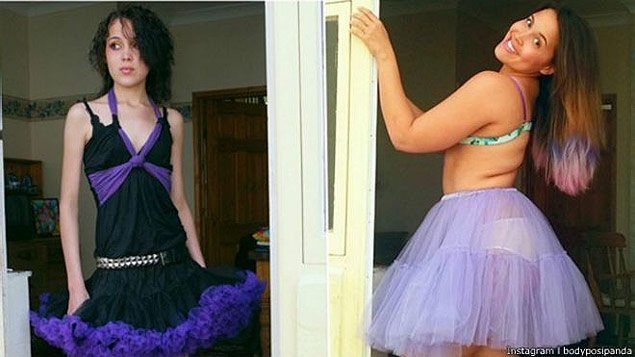 A britnica Megan Crabbe j foi anorxica e chegou a pesar menos que 30 quilos.