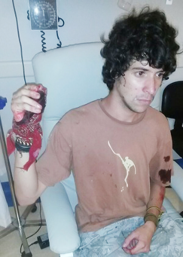 O estudante Gustavo Mascarenhas teve parte do polegar da mo direita dilacerado por um estilhao de bomba 