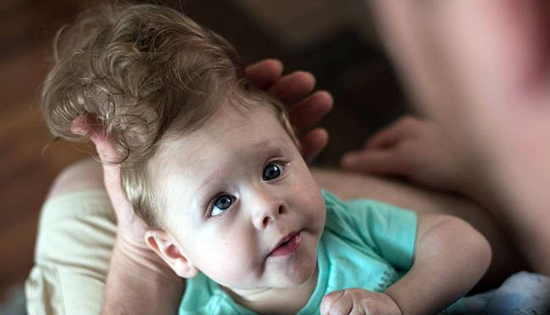 O beb que surpreendeu os mdicos ao sobreviver com o crebro fora do crnio