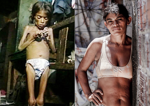 Meirinha se curou da desnutrio, mas hoje ainda vive na misria no Cear. 