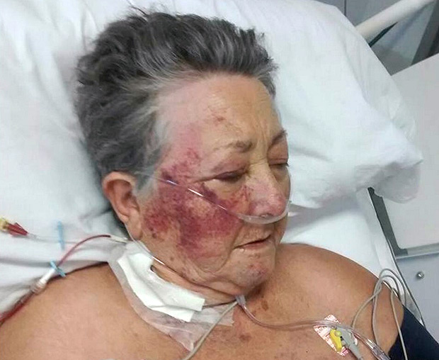 SAO PAULO,SP - 18/4/2017 - Thereza Aparecida, de 78 anos, internada na UTI do Hospital do Servidor Publico Municipal foi agredida por um enfermeiro na madrugada do ultimo domingo. Ele deu tapas no rosto da idosa, que se recupera de uma cirurgia vascular, apos ela pedir agua. A idosa ficou bastante machucada. O enfermeiro, Jamil Yoshiro Sazaki, que trabalha no hospital há 27 anos, foi afastado.(Foto: REPRODUCAO/Facebook, NAS RUAS) *** EXCLUSIVO AGORA SAO PAULO *** ***DIREITOS RESERVADOS. NO PUBLICAR SEM AUTORIZAO DO DETENTOR DOS DIREITOS AUTORAIS E DE IMAGEM***