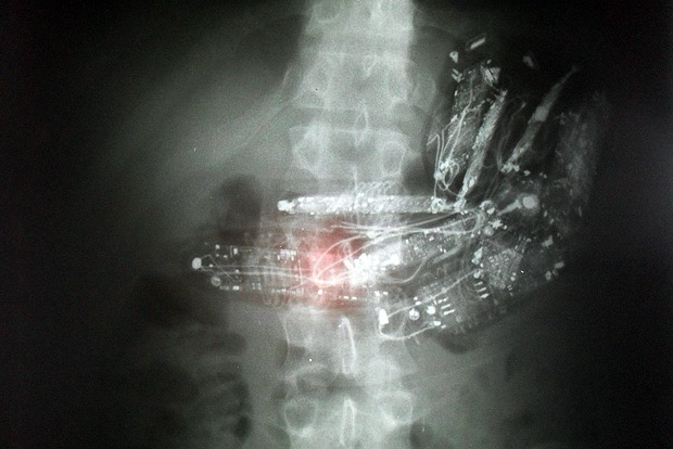 Aparelhos encontrados durante exame de raio-X no estmago de um preso do interior de SP