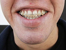Alexandre Pereira usa aparelho nos dentes há um ano e meio e deve tirá-lo até o fim do ano