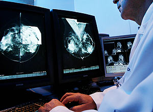 Radiologista observa imagens de mamografia; mdica oncologista que teve cncer de mama defende o exame