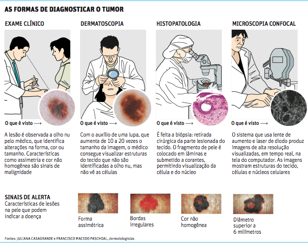 Cancerul de piele: simptome, diagnostic și tratamente - Știri | Anadolu Medical Center