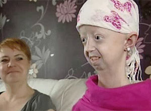 A britânica Hayley Okines sofre da forma mais severa da síndrome de progeria, uma condição genética rara
