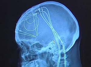 A técnica envolve o uso de fios e eletrodos implantados no cérebro por meio de furos abertos no crânio