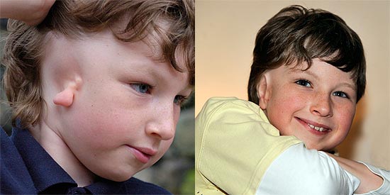 Síndrome fez com que ele nascesse sem uma das orelhas (à esquerda);
 Ethan ficou mais extrovertido após a cirurgia (à direita)