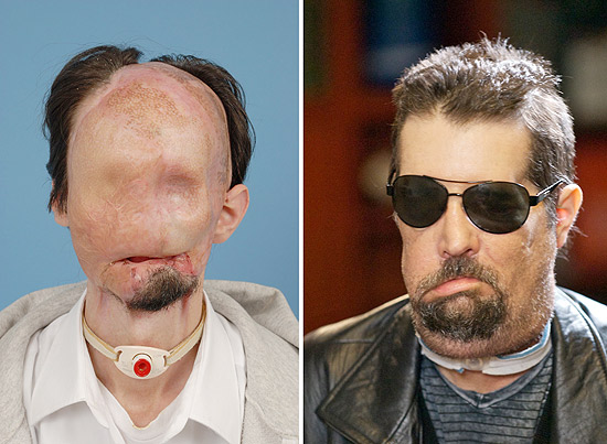 O paciente Dallas Wiens antes do transplante (à esquerda) e depois (à direita)