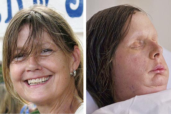 A americana Charla Nash antes do ataque (à esq.) e após o transplante de rosto (à dir.)