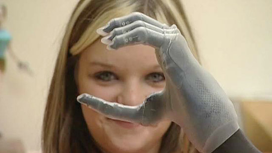 A estudante Chloe Holmes, 15, tornou-se a pessoa mais jovem na Europa a usar mão e dedos biônicos