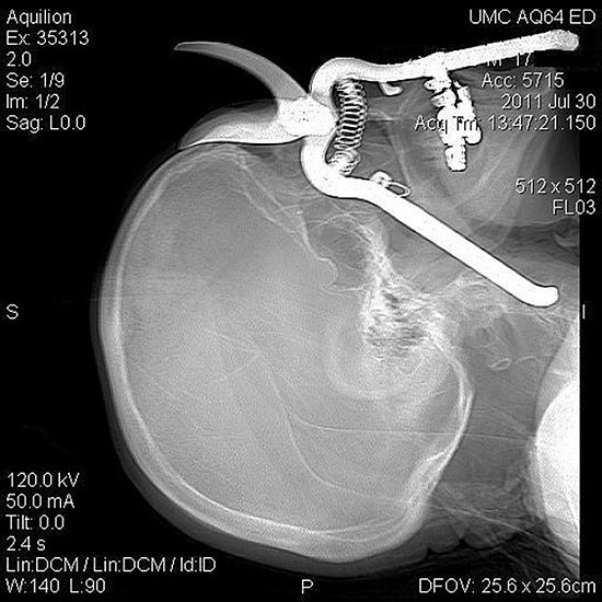 Raio-x mostra imagem do crânio do norte-americano perfurado pela tesoura de poda