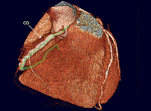 Tomografia da artria coronria <br>identifica bloqueios com preciso